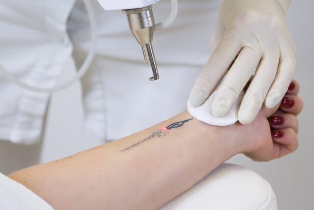 Dr. Jason Emer, MD, Reviews Tattoo Removal